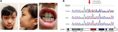 Neurodevelopmental disorders and anti-epileptic treatment in a patient with a SATB1 mutation: A case report
